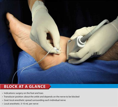 Ultrasound Guided Ankle Block Hadzic S Peripheral Nerve Blocks And