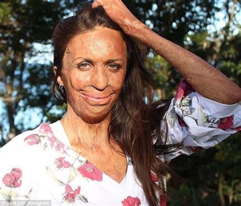 Burns Survivor Turia Pitt Undergoes Laser Surgery Before Nose Operation Daily Mail Online