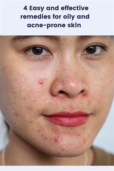 Oily Skin Is Basically A Result Of Overactive Sebaceous Glands Too
