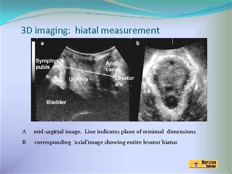 Imaging Of The Pelvic Floor Ultrasound And Mri