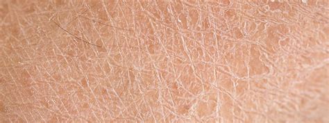 Dry Skin Frequently Asked Questions Faqs Emedicinehealth