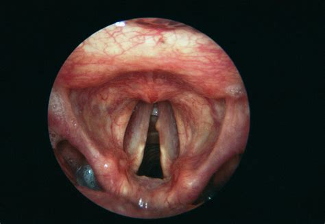 Vocal Cord Nodule Photograph By Cnri Science Photo Library My Xxx Hot