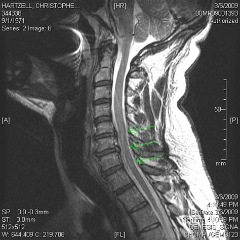 Disc In Neck Herniated Disc In Neck Nerve Damage