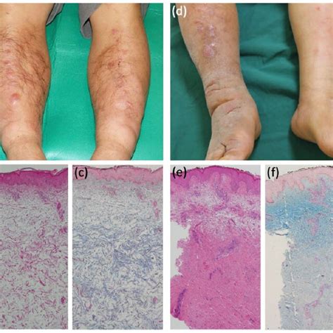 The Course Of The Patients Skin Lesions And Skin Specimen From The