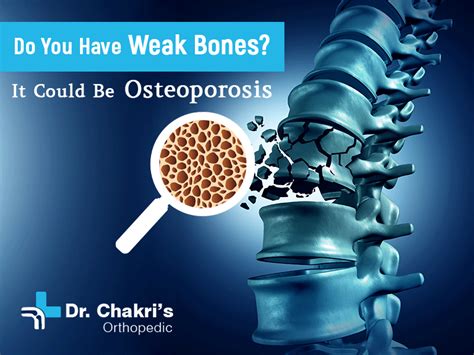 Do You Have Weak Bones It Could Be Osteoporosis Dr Chakradhar