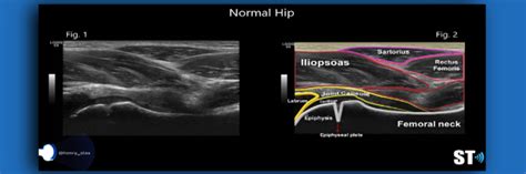 Ultrasound Of The Hip Sonographic Tendencies