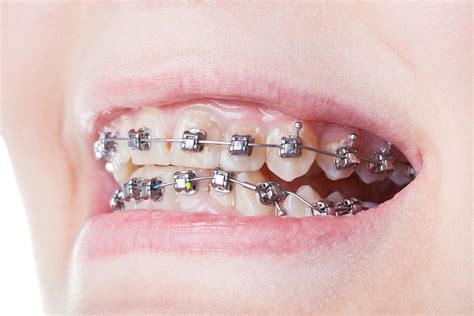 Damon Braces Vs Traditional Braces Benefits Treatment And Cost
