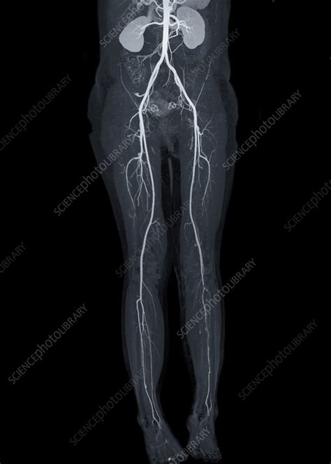 Healthy Abdomen And Lower Body X Ray Stock Image F0375569