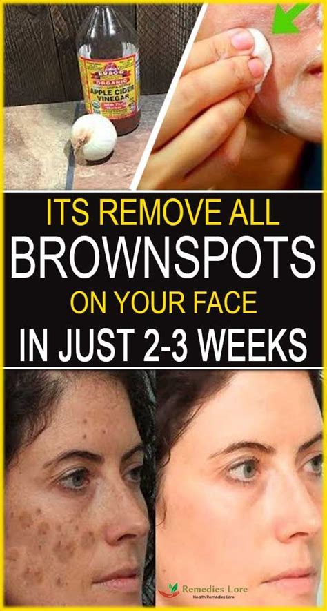 Simple Trick To Remove Brown Spots From Your Skin Brown Spots On Face