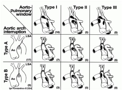 Aortopulmonary Window Rmi