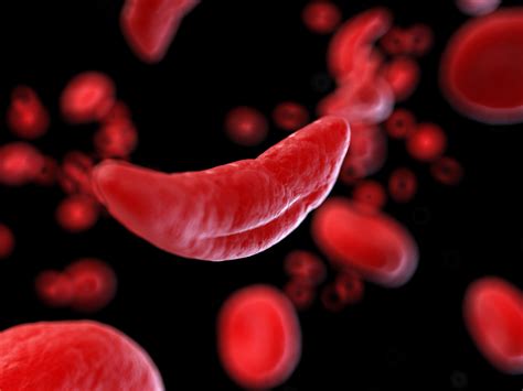 Anemia Falciforme La Prima Terapia Che Previene Crisi Dolorose Unica
