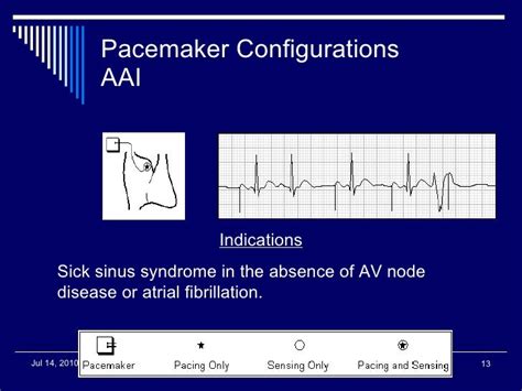 Pacer Ppt