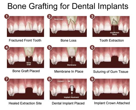 Understand Dental Bone Grafting From Springvale Dentist