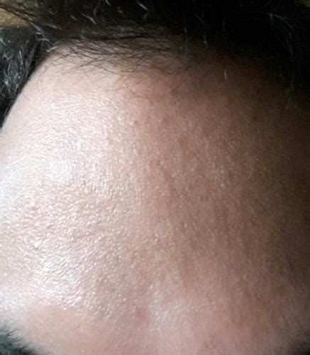 How Can I Get Rid Of These Little Bumps On My Forehead General Acne