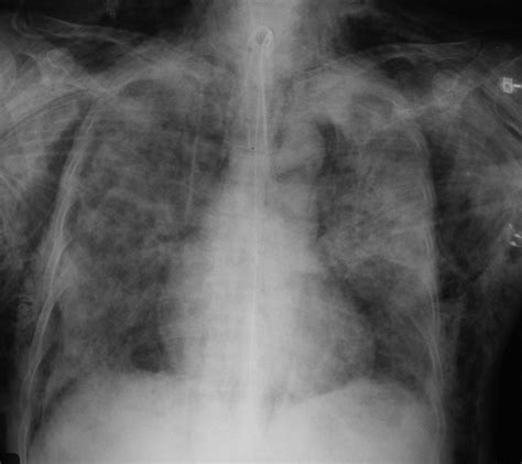 Pneumothorax Pneumomediastinum Subcutaneous Emphysema Cxr Frontal My