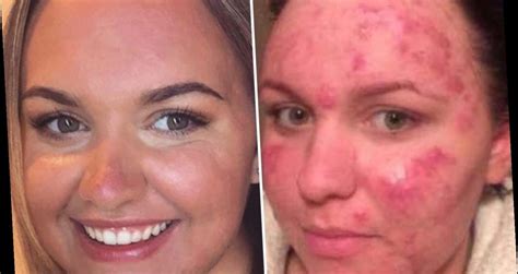 Woman With ‘boil Cysts All Over Face And Neck Forced To ‘choose Between