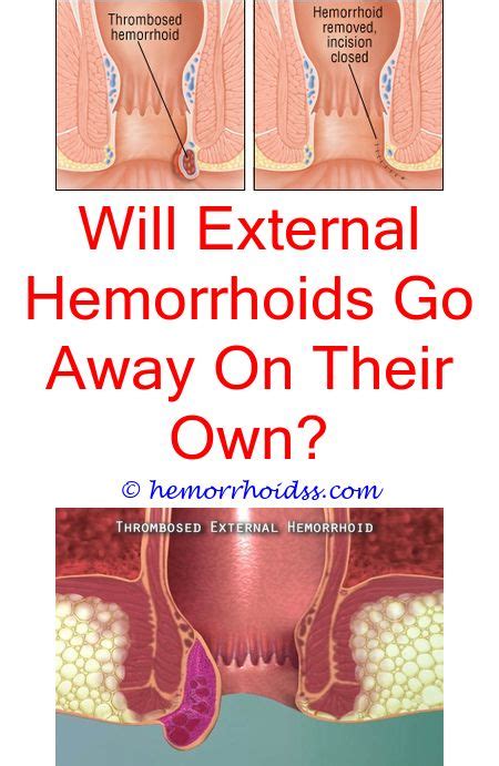 Pin On How To Treat External Hemorrhoids