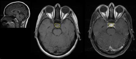 radiological anatomy pituitary gland stepwards