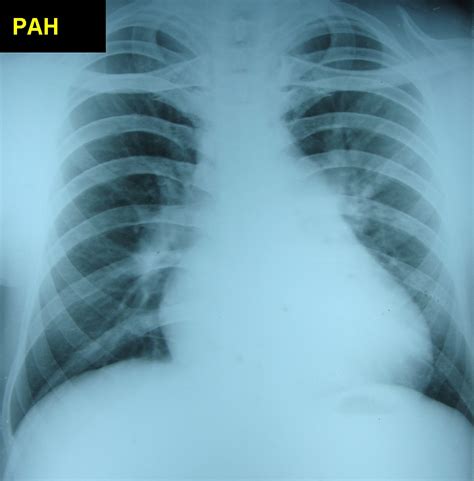 Pulmonary Hypertension Progressive On Serial Chest X Rays All