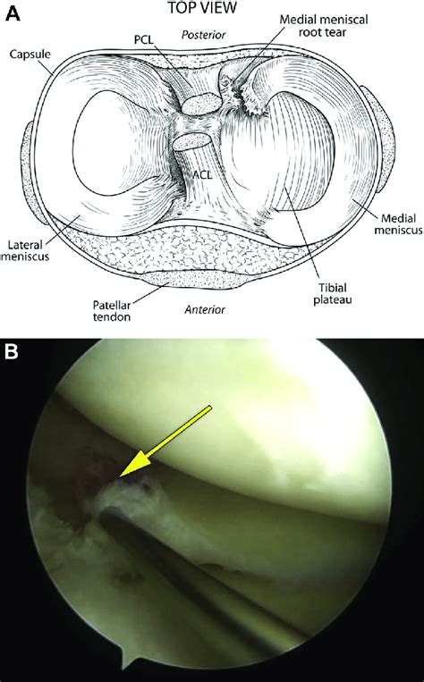 A Top View Of The Knee Showing A Medial Meniscal Posterior Root Tear