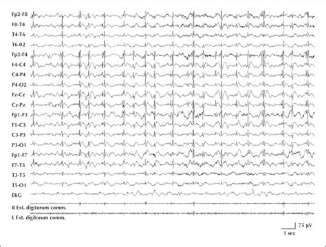 Myoclonic Status Epilepticus Documented By Video Eeg Including