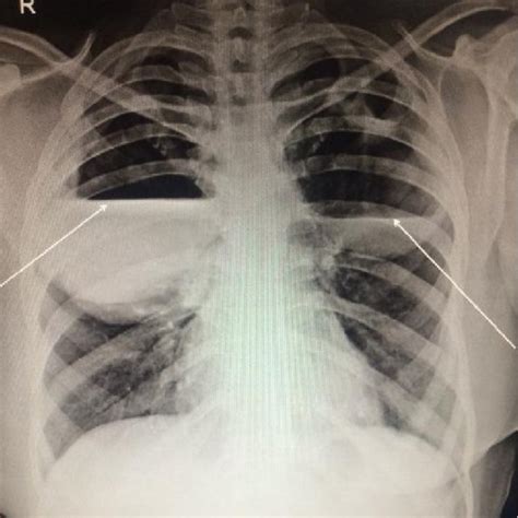 Showing Bilateral Lung Abscess On Lateral Chest Xray View Download