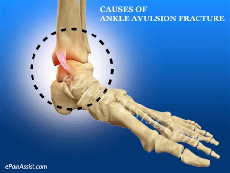 Causes Of Ankle Avulsion Fracture By Epainassist Find Share On