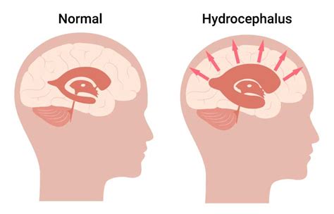 Hydrocephalus In Infants Symptoms Treatment And Legal Help
