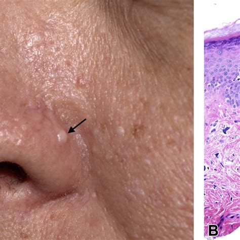 Gross And Microscopic Appearances Of Papules On The Patients Face A