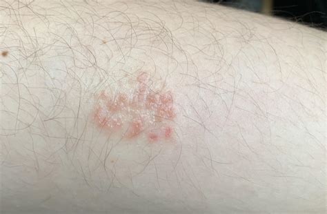 Could Anyone Identify What This Rash Is Its On The Back Of My Upper