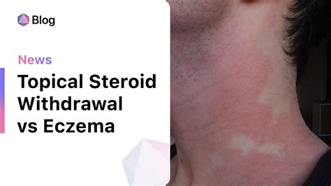 Demystifying Topical Steroid Withdrawal In Eczema Patients