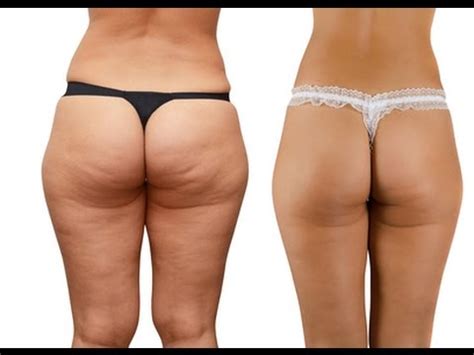 Cellulite Gone Review How To Get Rid Of Cellulite On Thighs YouTube