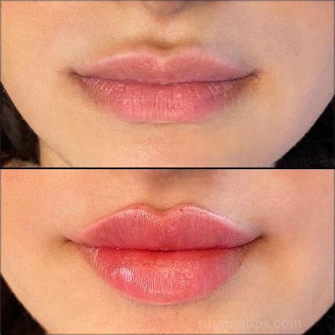 Russian Lip Filler On Thin Lips
