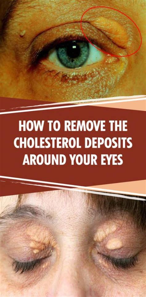 How To Remove The Cholesterol Deposits Around Your Eyes Eye Wellness