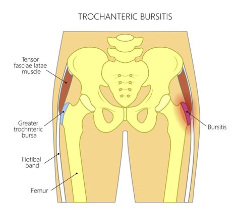 Hip Trochanteric Bursitis Tendinitis CHARM