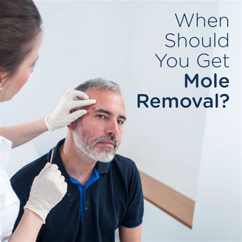 When Should You Get Mole Removal Skin Wellness Dermatology