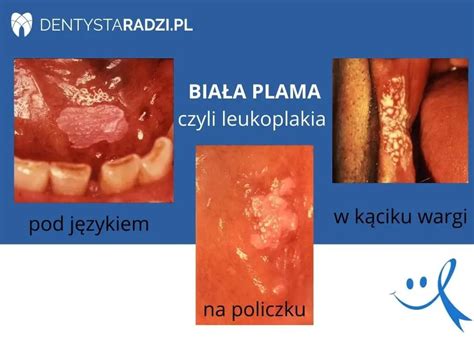 Rak Jamy Ustnej Co Powinienem Wiedzieć