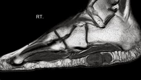 Mri and ultrasound have been utilised in the assessment of the plantar intrinsic foot muscles. MY E-RADIOLOGY CASES: CASE 512 : 25 year-old girl with a ...