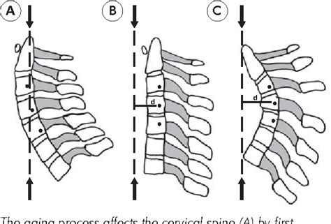 Figure 2 From The Biomechanics Of Cervical Spine Deformity Correction