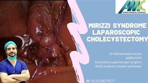 Mirizzi Syndrome Laparoscopic Cholecystectomy By Dr Usman YouTube