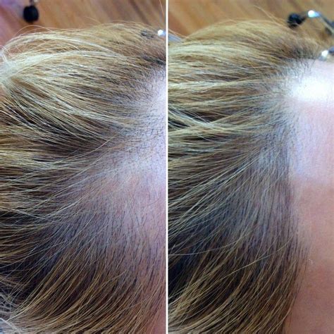 Everything You Need To Know About Microblading For Hair Loss Hair