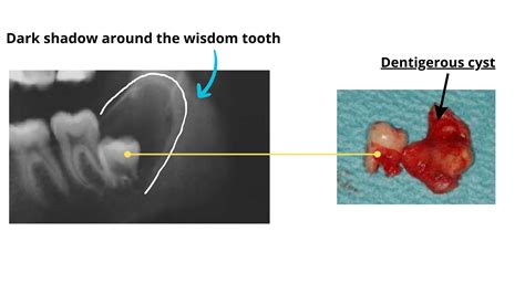 Wisdom Tooth Cyst A Potential Complication Explained