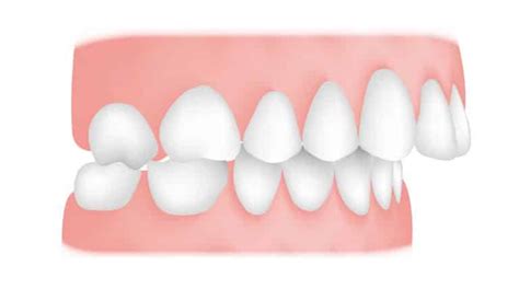 Treatment Of Malocclusion Smile Solutions