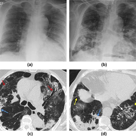 The Incidence Of Lymph Nodes Enlargement And Pleural Effusion Among