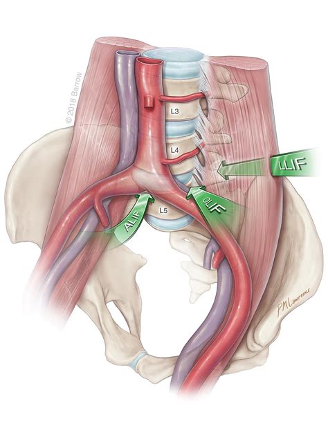 What Is ALIF Surgery Barrow Neurological Institute