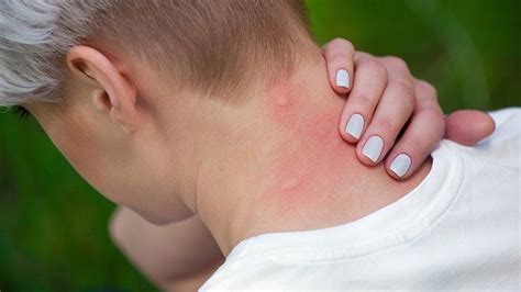Why Mosquito Bites Itch And How To Get Relief