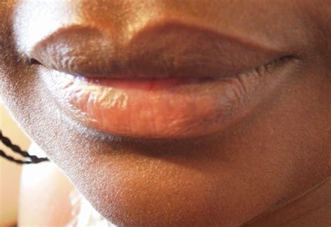 Dermatite periorale: cos'è, sintomi e cura