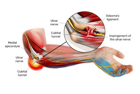 Cubital Tunnel Syndrome Treatment In Montreal By Dr Durand