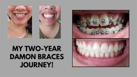 Comprehensive Damon Braces Video Full Two Year Process W Updates Youtube