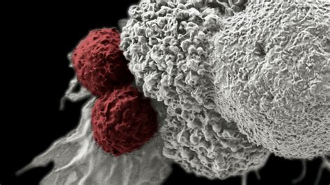 Cancer Cell Under Electron Microscope